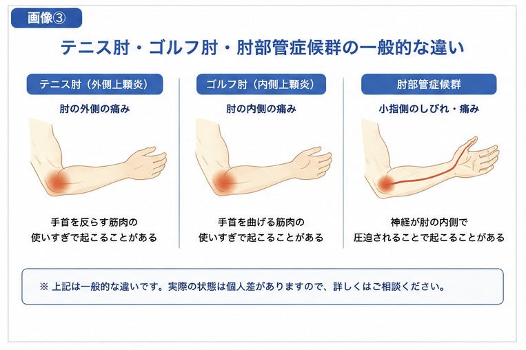 テニス肘とゴルフ肘・肘部管症候群の一般的な違い