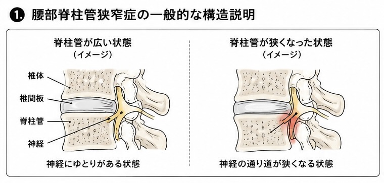 腰部脊柱管狭窄症の一般的な構造説明