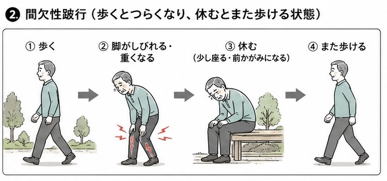間欠性跛行の流れを説明するイラスト
