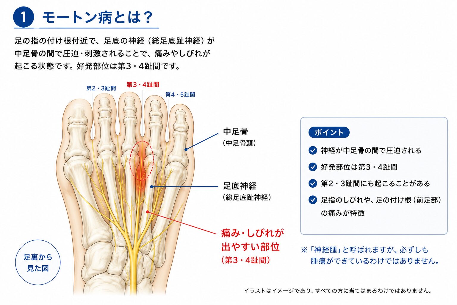 モートン病で痛みやしびれが起こりやすい前足部の一般的な構造図