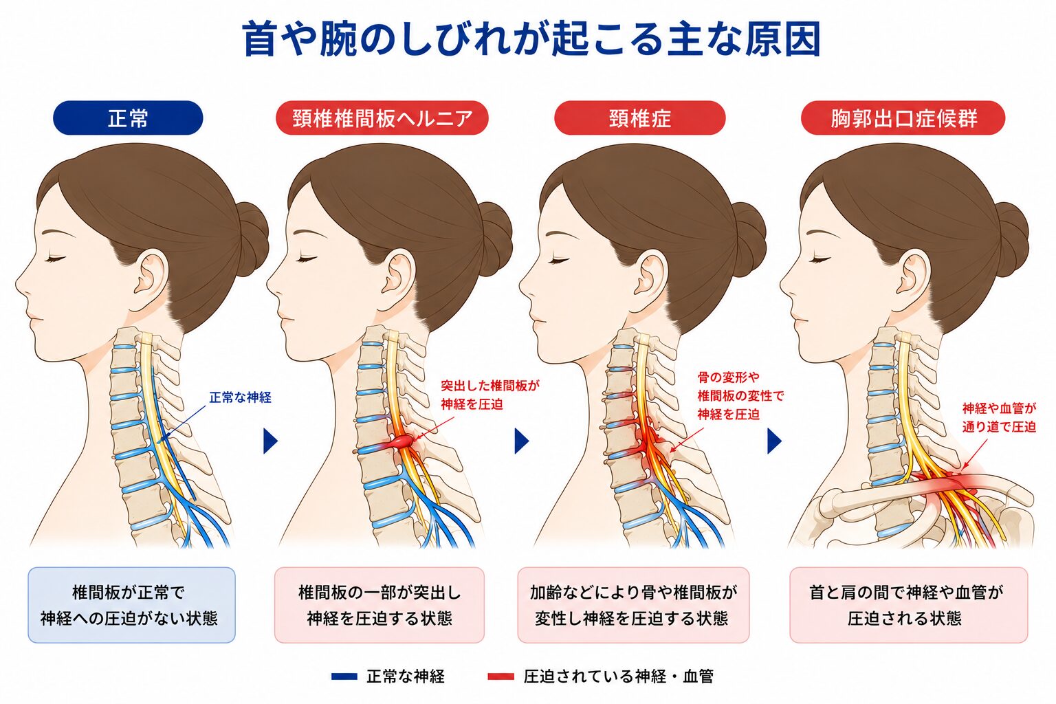 首や腕のしびれが起こる一般的な原因比較図