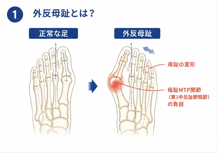 外反母趾の一般的な構造図
