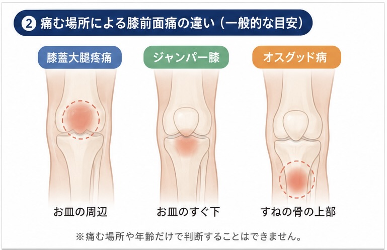 オスグッド病・膝蓋大腿疼痛・ジャンパー膝の痛む場所の一般的な目安