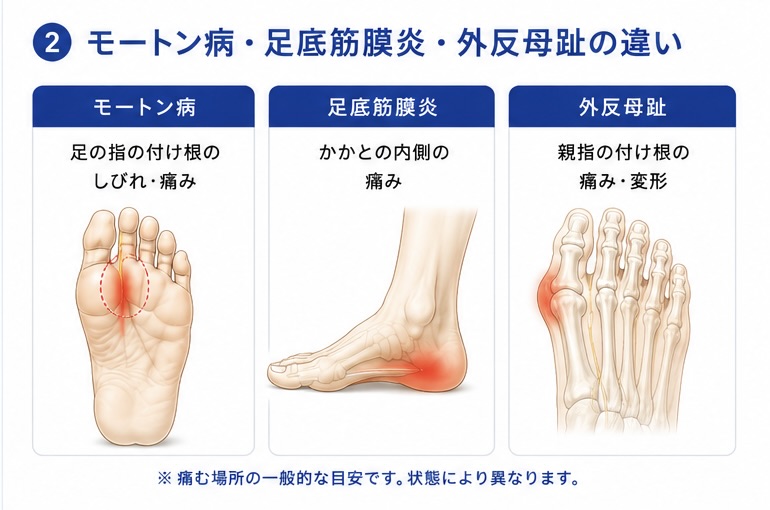 前足部や足裏の痛む場所の一般的な目安