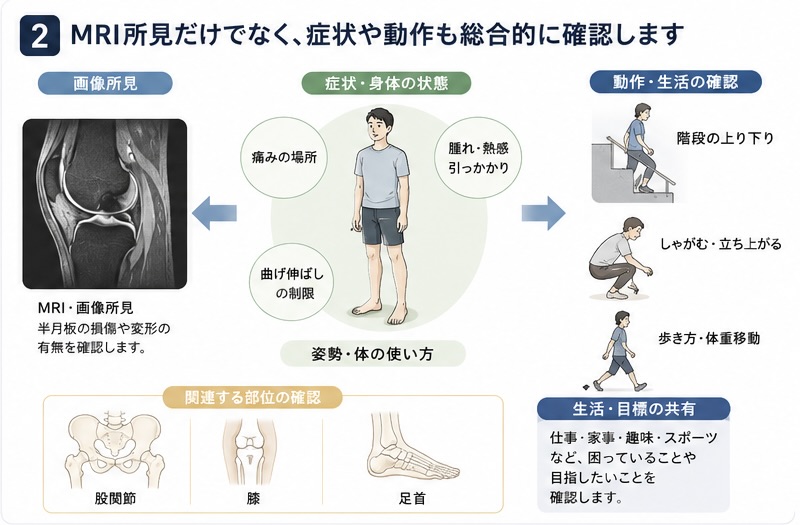 半月板損傷はMRI所見だけでなく症状や動作も確認する図