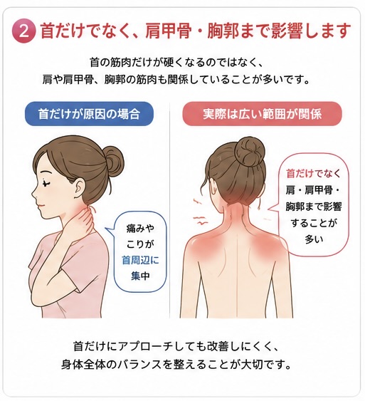 寝違えで首だけでなく肩甲骨や胸郭まで影響することを示す図解