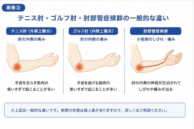 テニス肘・ゴルフ肘・肘部管症候群の一般的な違い