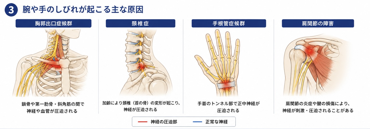 腕や手のしびれの一般的な原因比較図