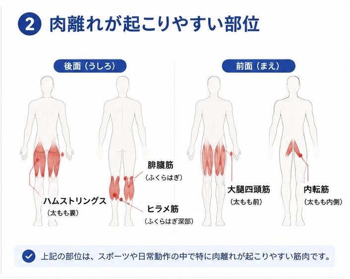 スポーツで起こりやすい脚の痛みの一般的な違い