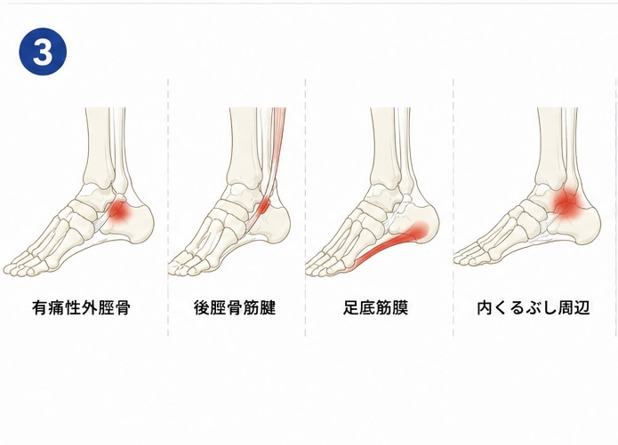 足の内側に痛みが出やすい部位の一般的な比較図